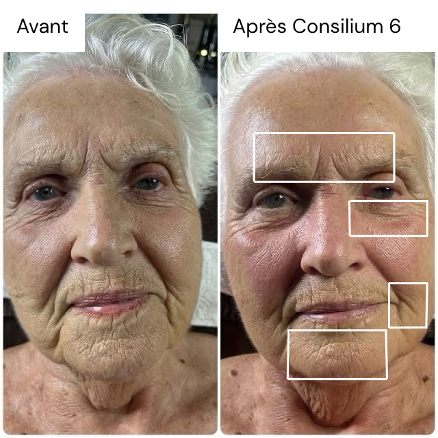 Images avant / après d'un visage suite a un soin avec le Consilium 6 