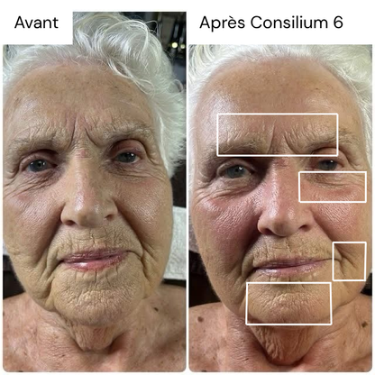 Images avant / après d'un visage suite a un soin avec le Consilium 6 
