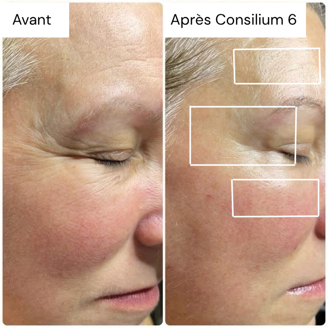 Images avant / après d'un visage suite a un soin avec le Consilium 6 
